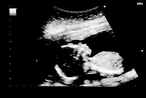 Ultrasound of baby in mother's womb.